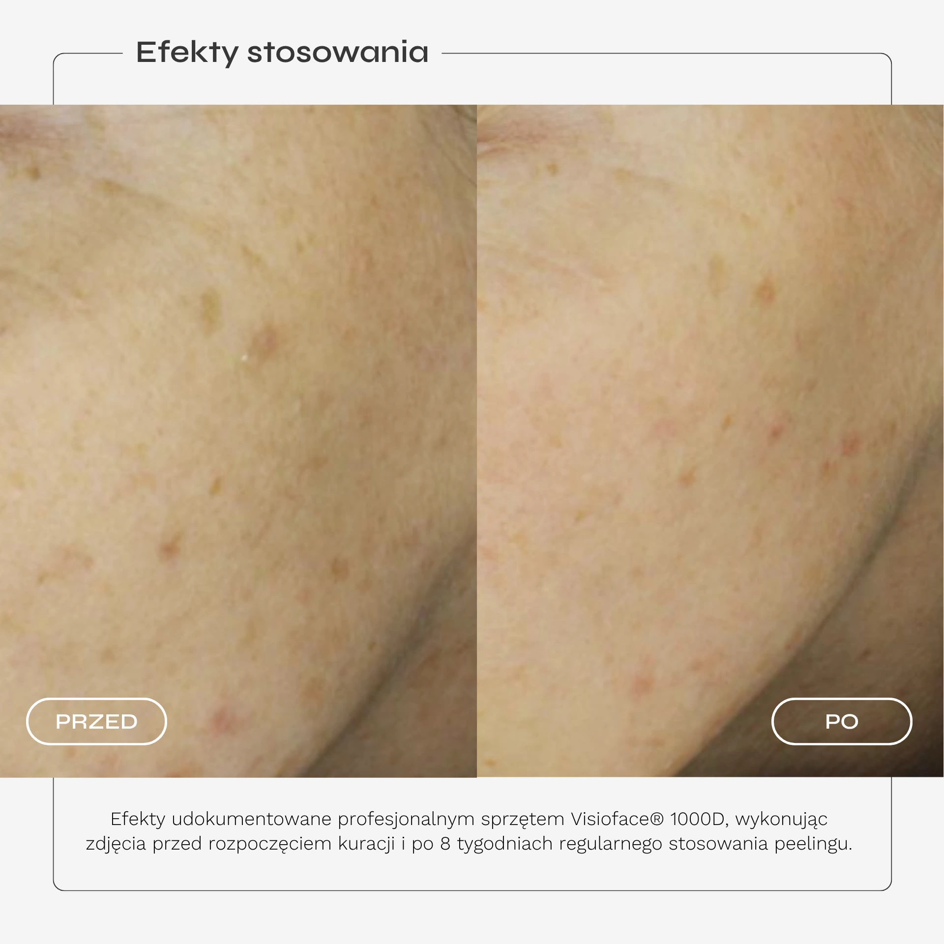 peeling-kwasowy-karta-produktu-08.webp