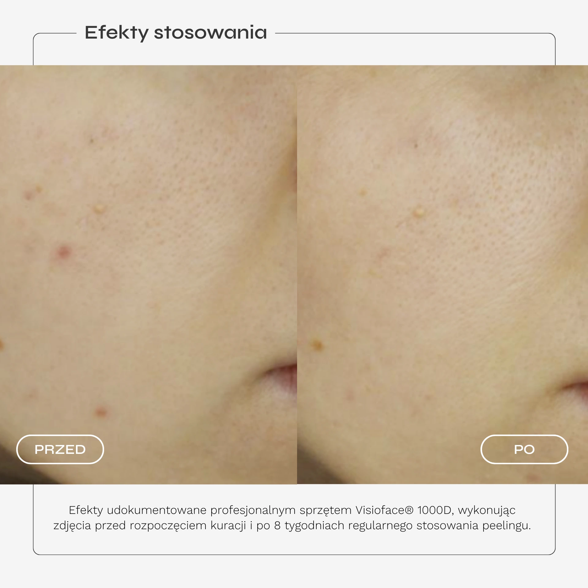 peeling-kwasowy-karta-produktu-07.webp