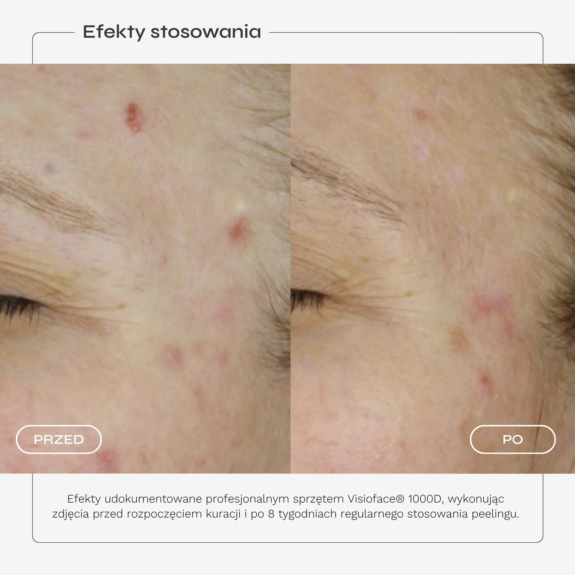 peeling-kwasowy-karta-produktu-06.webp