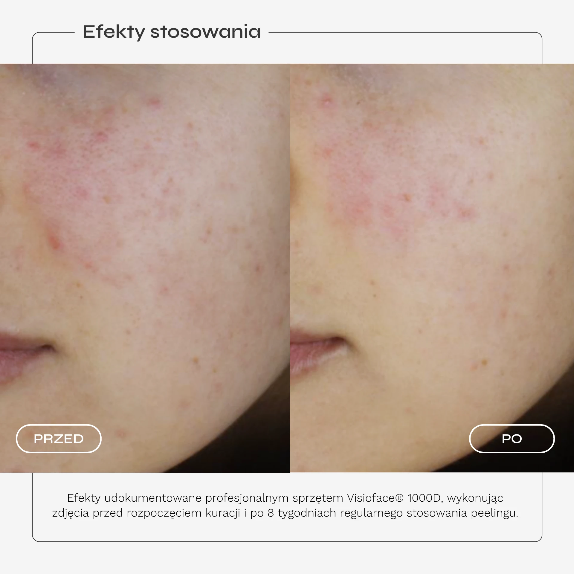 peeling-kwasowy-karta-produktu-05.webp