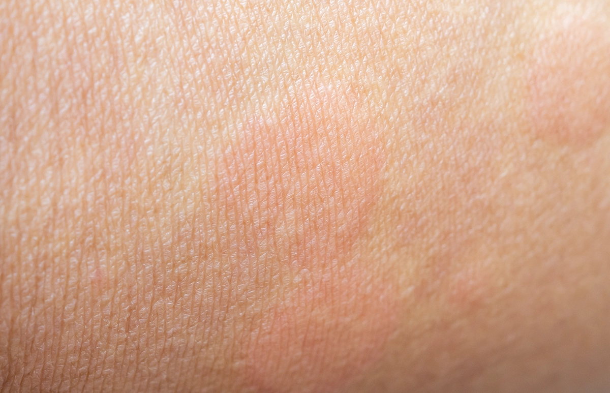 Podrażnienie skóry