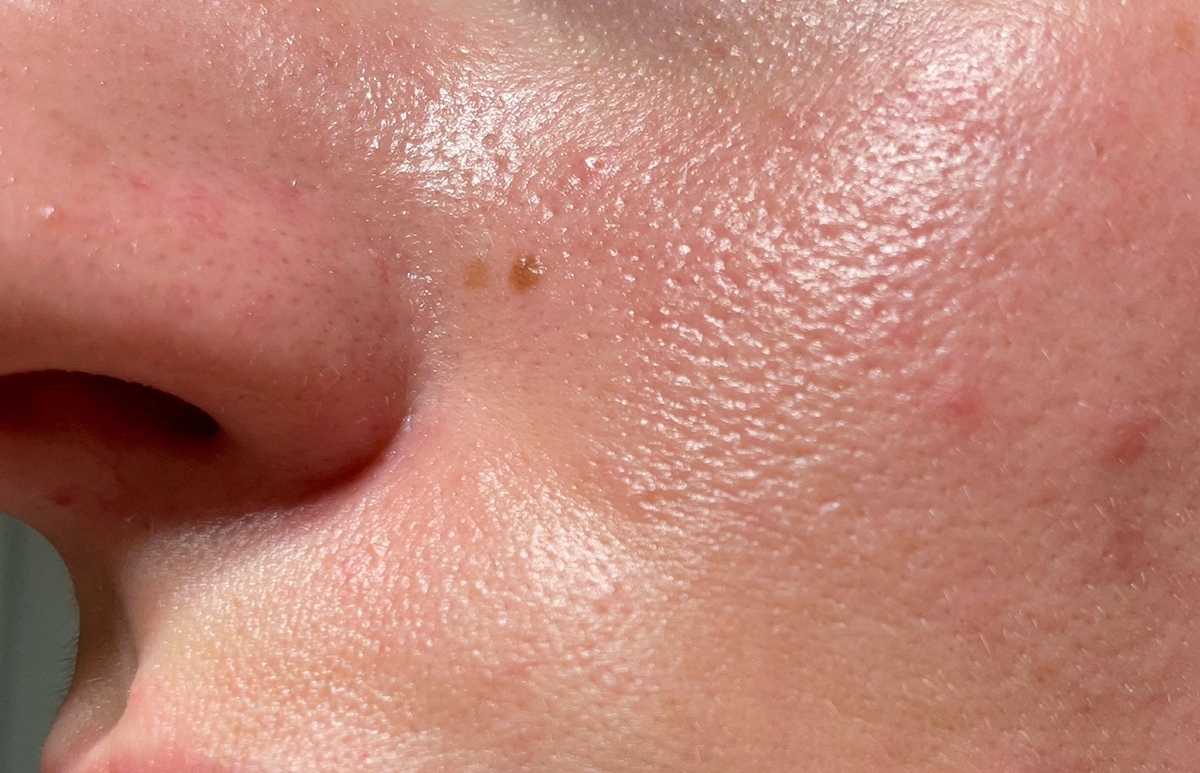 Nadmiar sebum